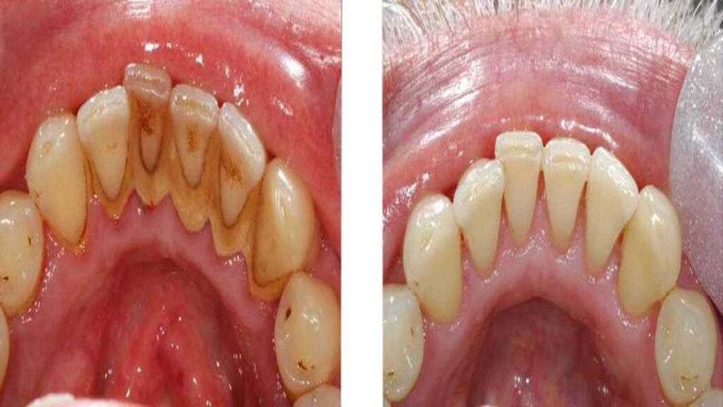 plaque and tartar build up Creekside Dental