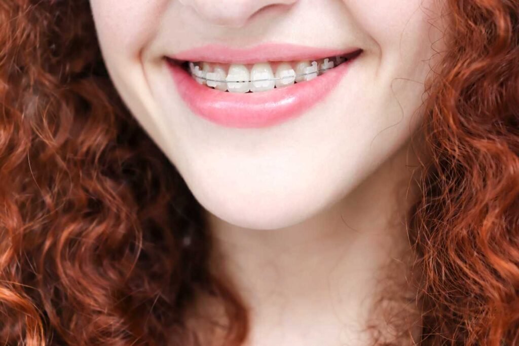 ceramic braces Creekside Dental