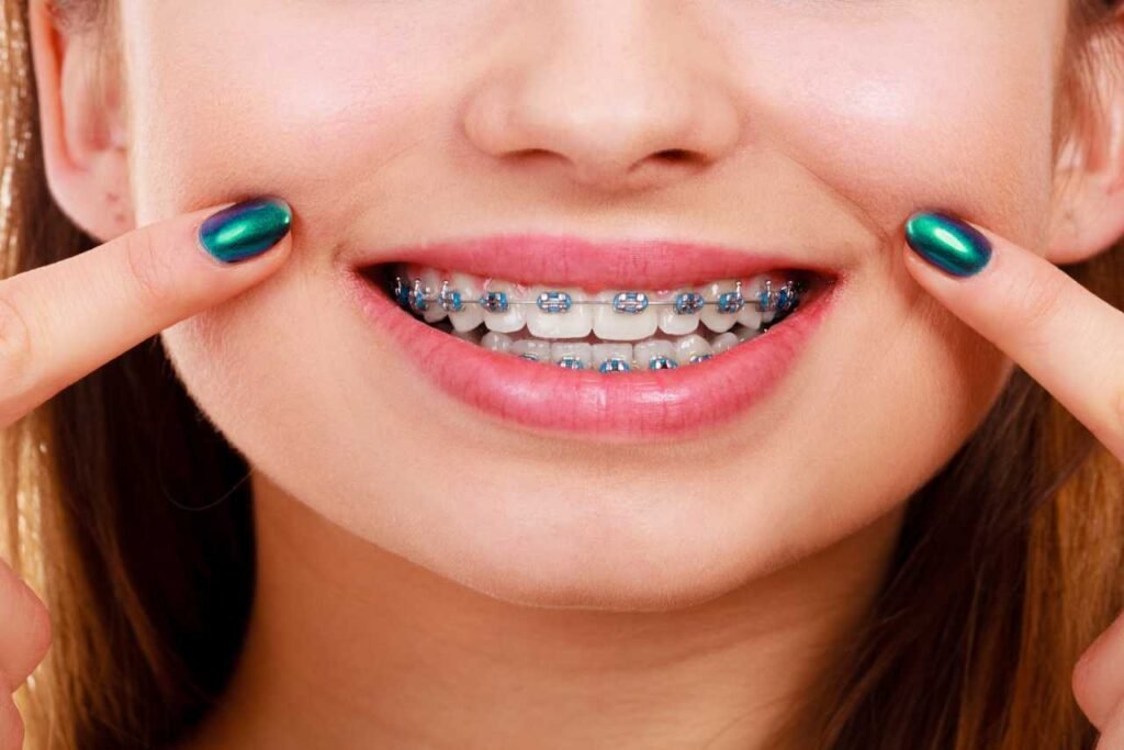 traditional metal braces Creekside Dental