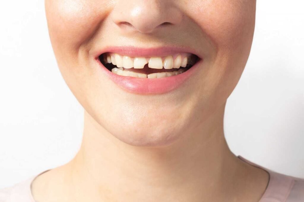 chipped or broken tooth emergency dental care Creekside Dental