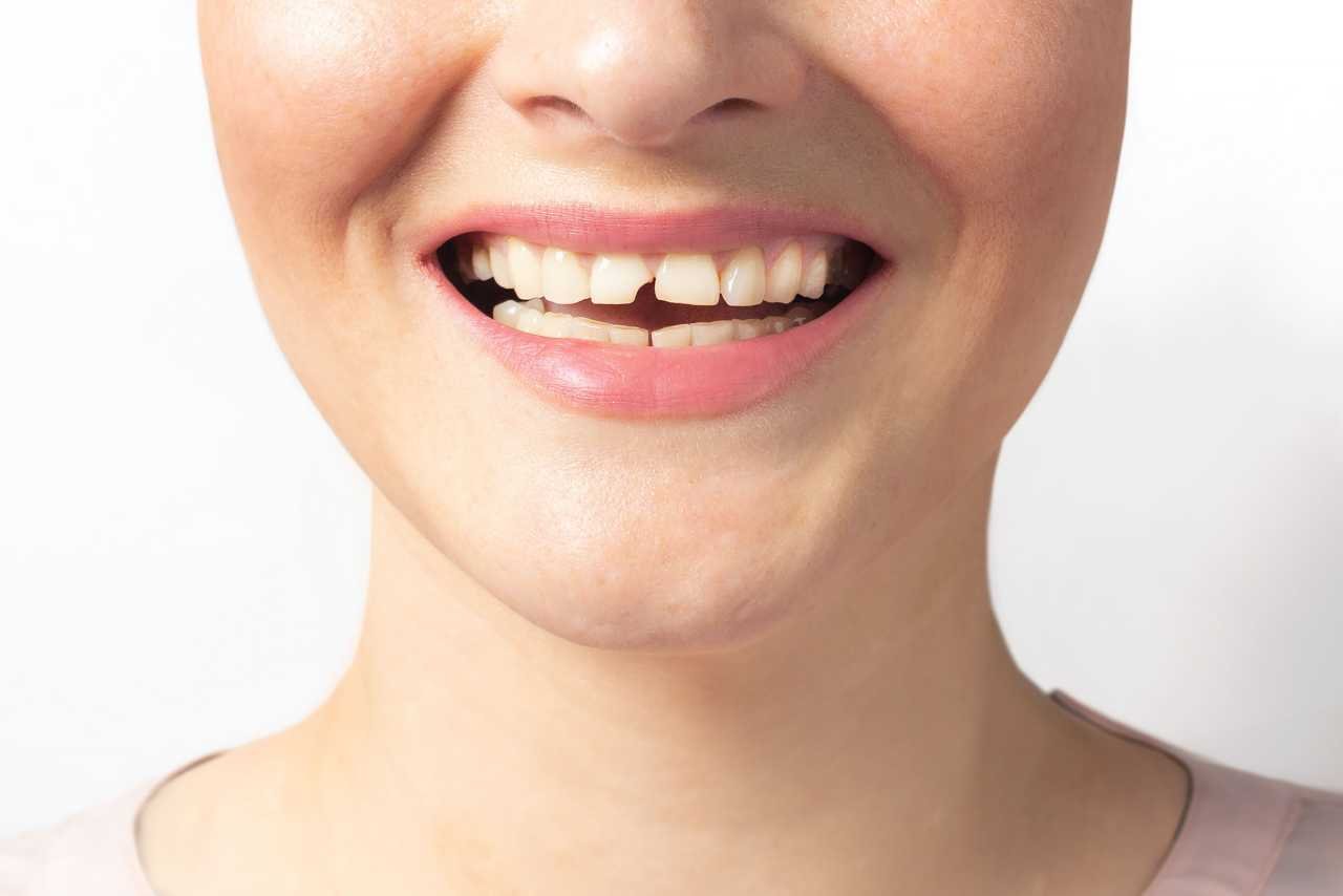 chipped or broken tooth emergency dental care Creekside Dental