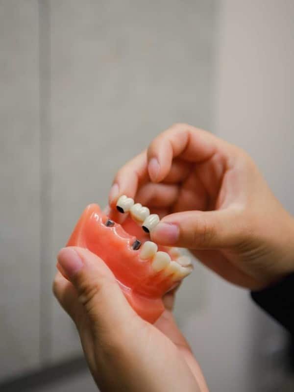 dental crowns in Kennewick