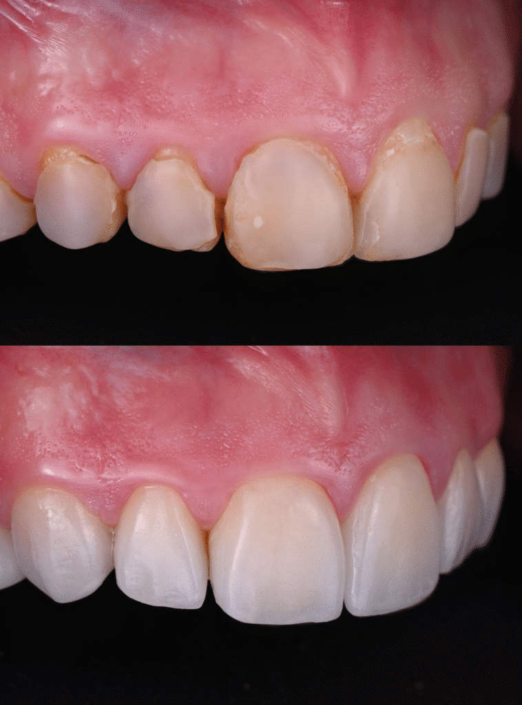 Prosthodontic Care -Veneers